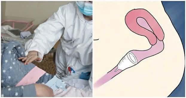 Cô gái suy kiệt vì ‘chiếc cốc’ nằm im 7 tháng, đi viện không lấy được: Cảnh báo cho chị em