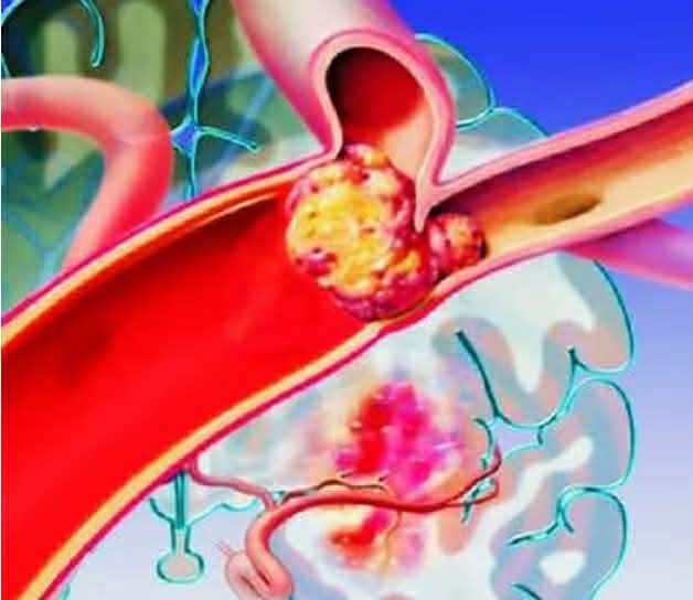Sáng thức dậy gặp 6 dấu hiệu này, coi chừng “đột quỵ”
